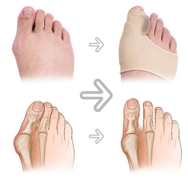 Noćna navlaka za palac stopala – par – slika 9